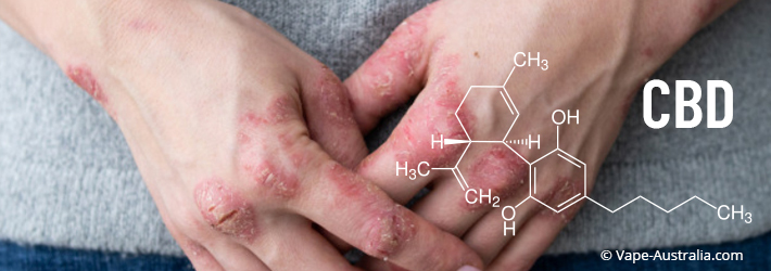 cbd-and-psoriasis